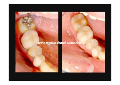ダイレクトボンディング治療中の様子